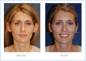 rhinoplasty plastic surgeons in minneapolis James A Hoffman MD Cosmetic and Plastic Surgery